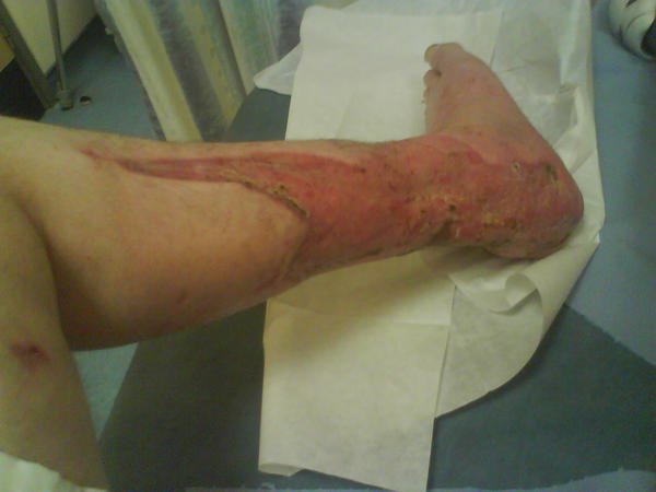 my_leg_injuries_now__by_lightningtremlett.jpg