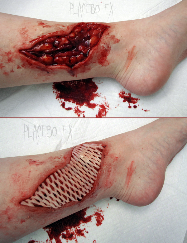 Plastic Surgery for Burns and Other Wounds: Skin Grafts ...